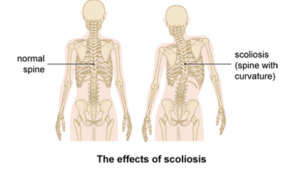 scoliosis normal and curved