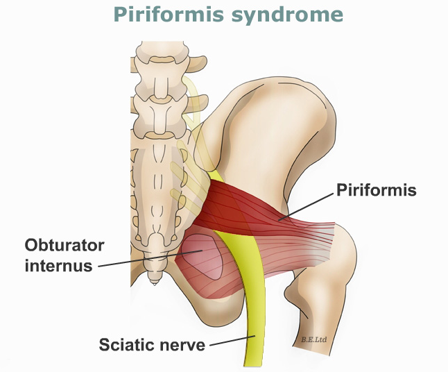 Piriformis-syndrome[1]