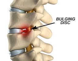 spine with bulging disc low back