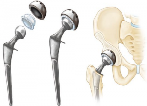 hip socket replacement